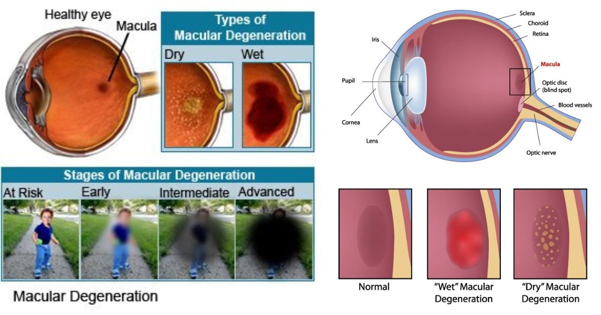 A Guide To Macular Degeneration The Leading Best Cause Of Vision Loss 2023