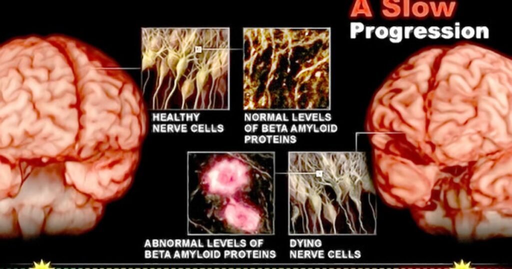 Know Your Risks for Dementia, Including Alzheimer's Disease