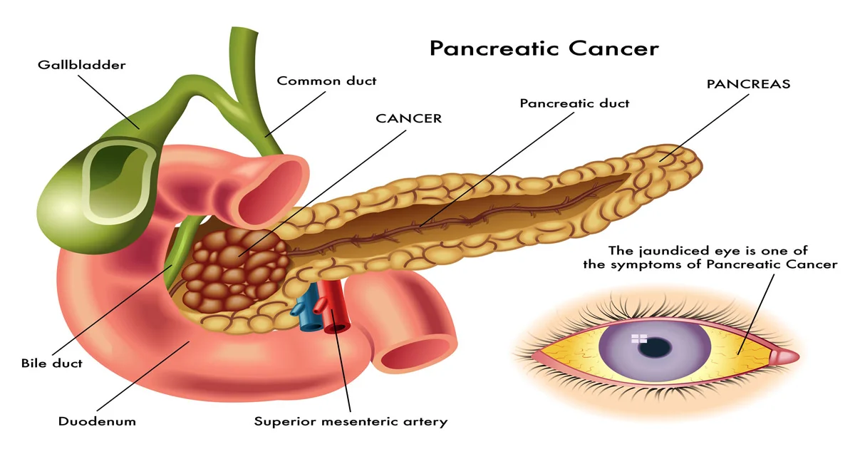 Pancreatic Cancer Statistics, Facts, Incidence Rates