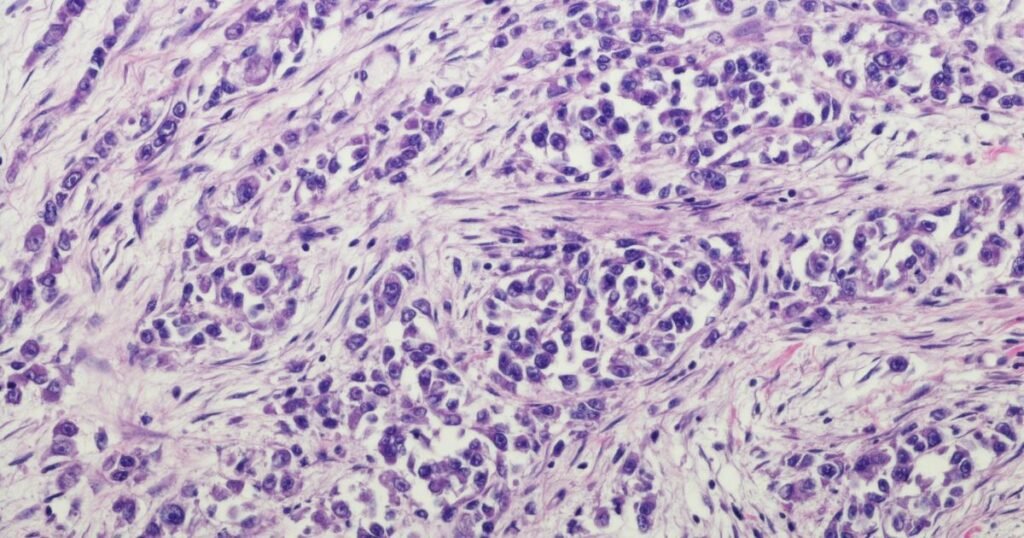 Spindle cell sarcoma