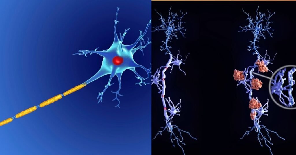 Damegde Multiple Sclerosis