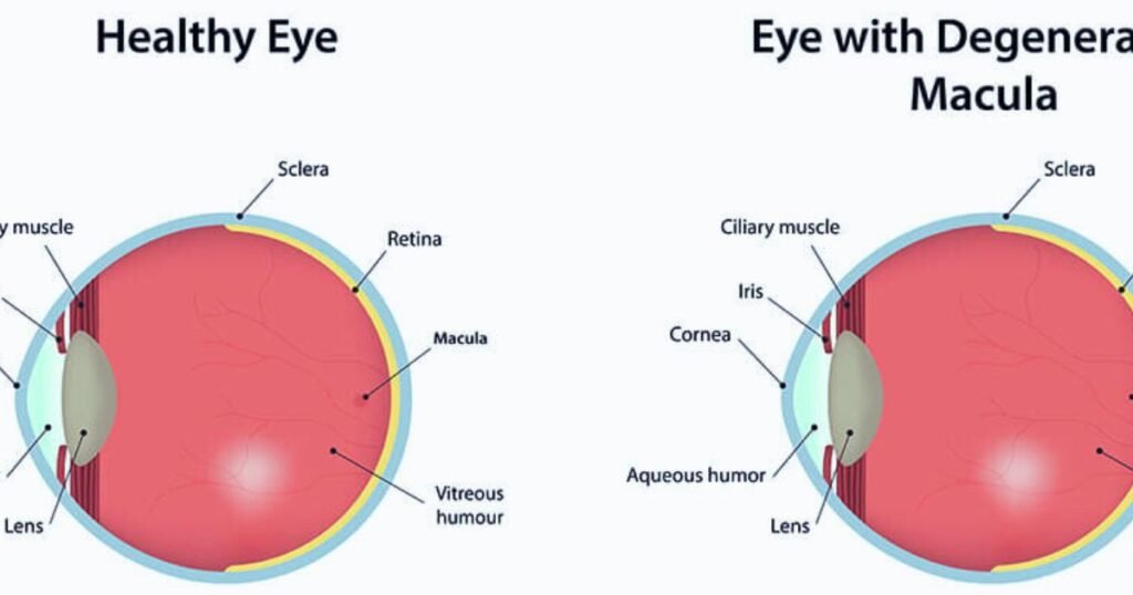 Macular Degeneration Morgantown Regional Eye Associates