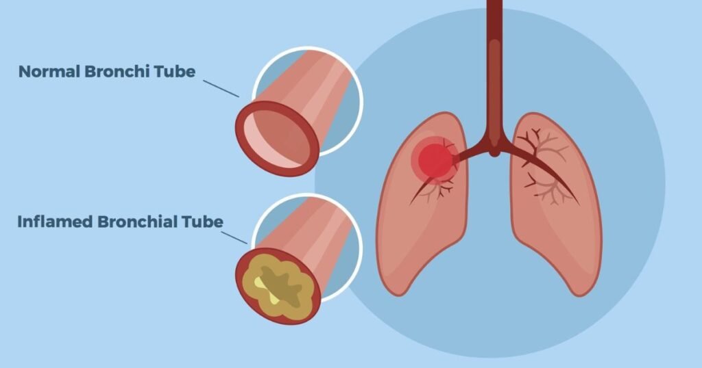 Causes of Chest Congestion