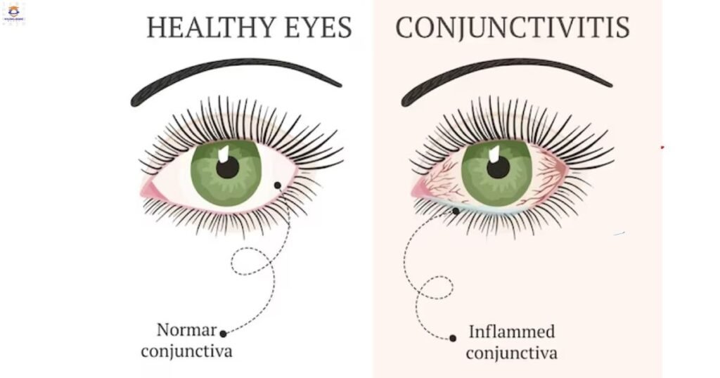 Ophthalmology Eye Disease