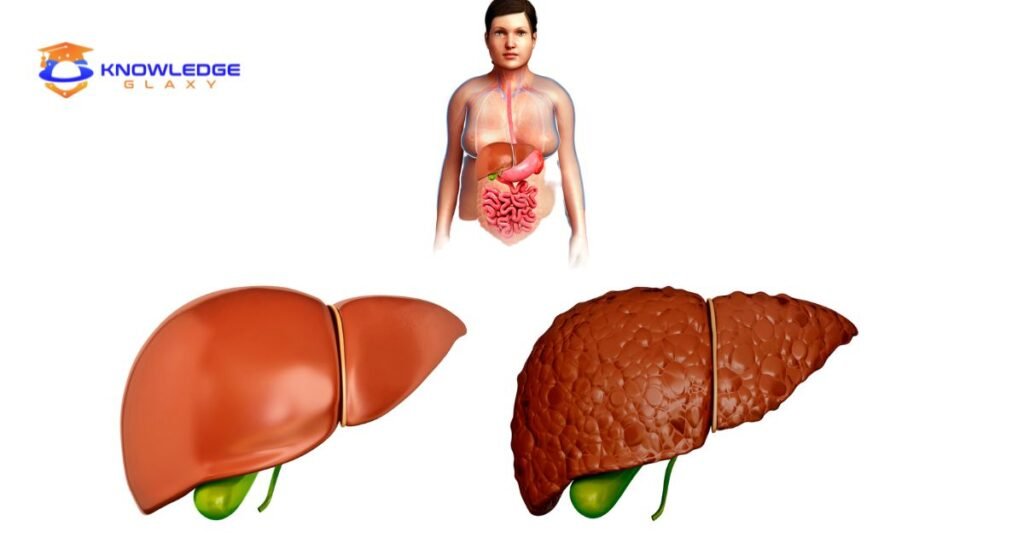 Fatty Liver Disease 2023