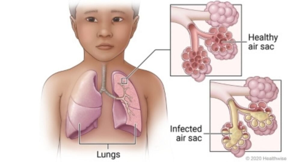 Pneumonia in Children Care Instructions